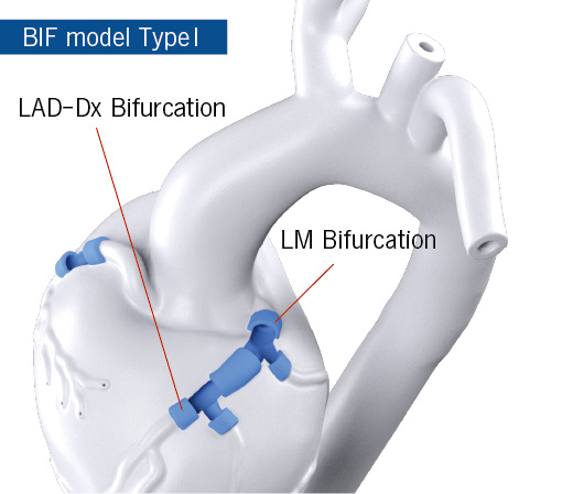 LM bifurcation with LAD-Dx bifurcation