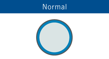 Normal